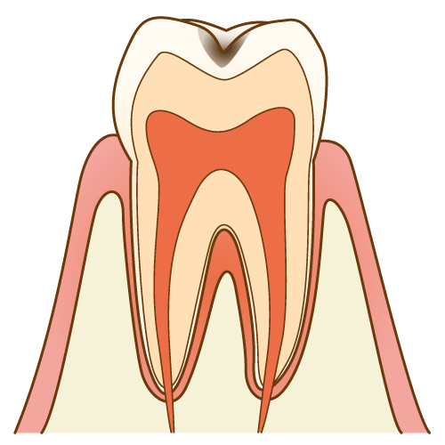 虫歯(C1)