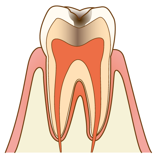 虫歯(C2)