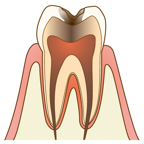 虫歯(C3)