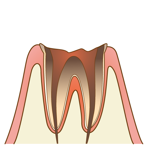 虫歯(C4)