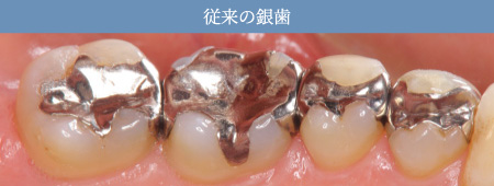 一般的な銀歯治療